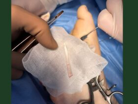 стороннє тіло, видалення