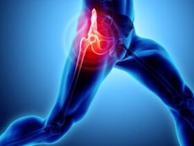 артропластика