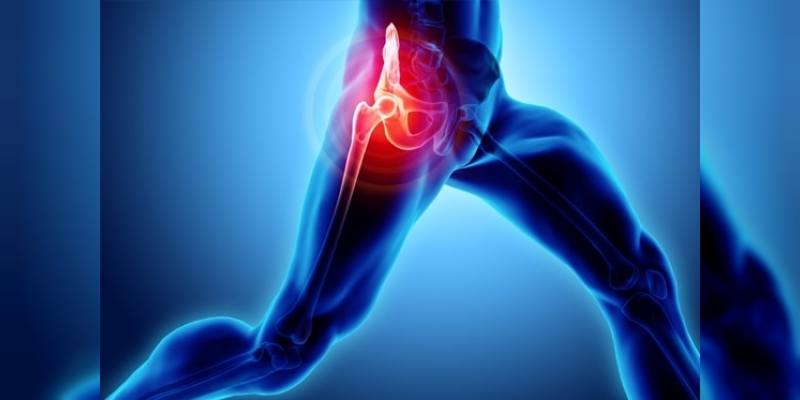 артропластика