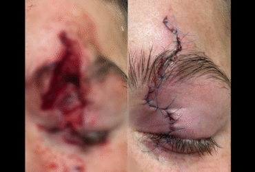 повіки, травма