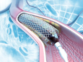 Планове стентування судин