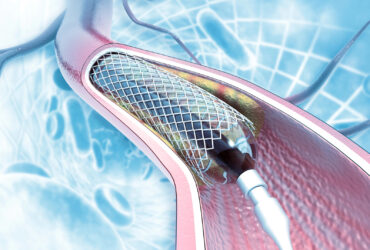 Планове стентування судин